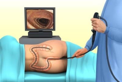 Anoskopija - specijalistički pregled zadnjeg dela debelog creva i hemoroida